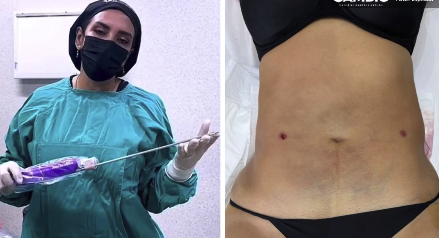 “Chips sexuales” y lipos a bajo costo: el oscuro menú de la clínica Detox donde desapareció Blanca Adriana